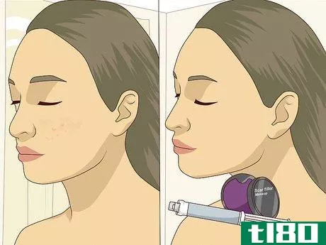 Image titled Get Rid of Dark Spots on Your Face Step 11
