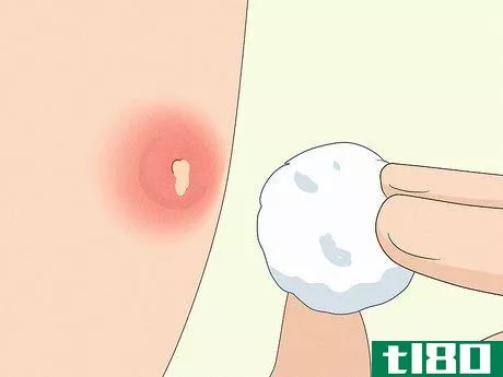 Image titled Instantly Get Rid of a Pimple (Cotton Ball Popping Method) Step 4