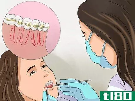Image titled Get Your Braces off Faster Step 3