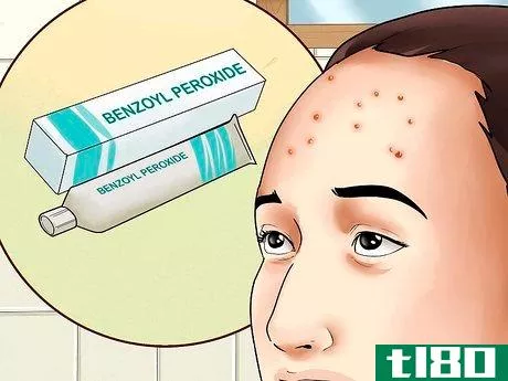 Image titled Get Rid of Forehead Acne Step 1