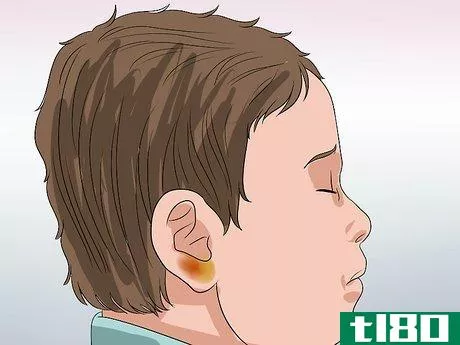Image titled Know if You Have Otitis Media Step 12