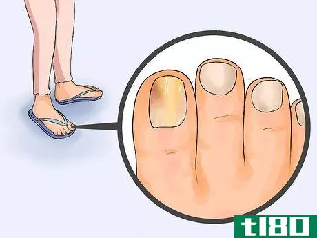 Image titled Get Rid of Toe Fungus Step 1