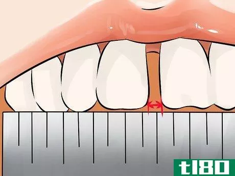 Image titled Get Rid of Gaps in Teeth Step 3