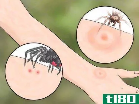 Image titled Identify Insect Bites Step 7