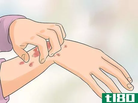 Image titled Identify an HIV Rash Step 1