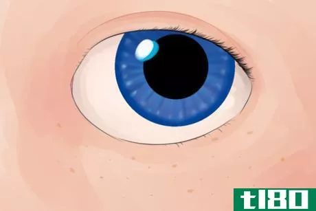 Image titled Down Syndrome Eye.png