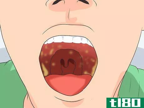 Image titled Recognize the Strep Throat Symptoms Step 2