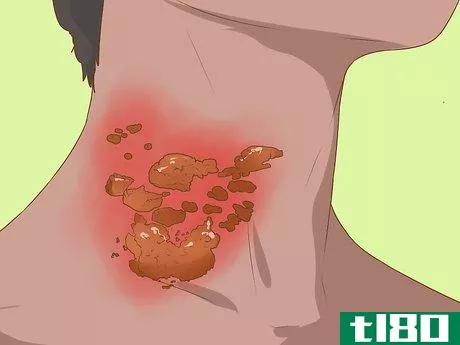 Image titled Recognize Shingles Symptoms (Herpes Zoster Symptoms) Step 5