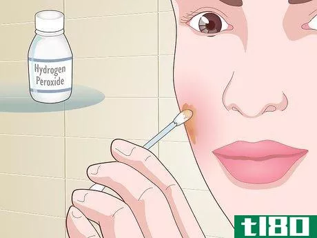 Image titled Prevent Acne Naturally Step 16