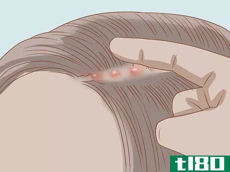 Image titled Recognize Head Lice Step 8