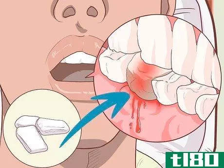 Image titled Prepare for Tooth Extraction Step 11