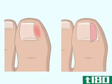 Image titled Relieve Ingrown Toe Nail Pain Step 25
