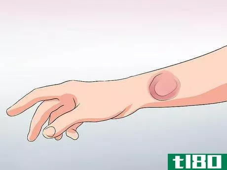 Image titled Recognize Lyme Disease Symptoms Step 1