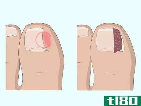 Image titled Relieve Ingrown Toe Nail Pain Step 26