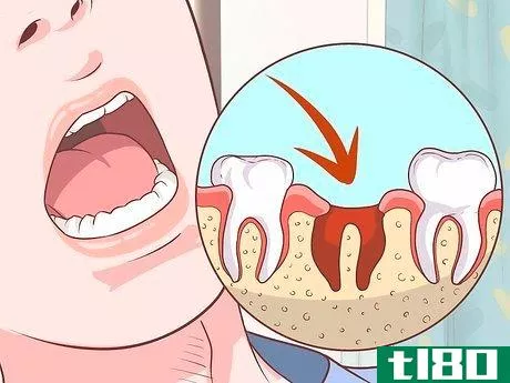 Image titled Prepare for Tooth Extraction Step 17