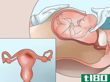 Image titled Recognize Symptoms of a Postpartum Hemorrhage Step 3