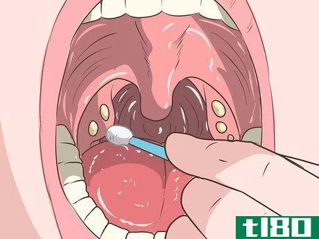 Image titled Remove Tonsil Stones (Tonsilloliths) Step 5