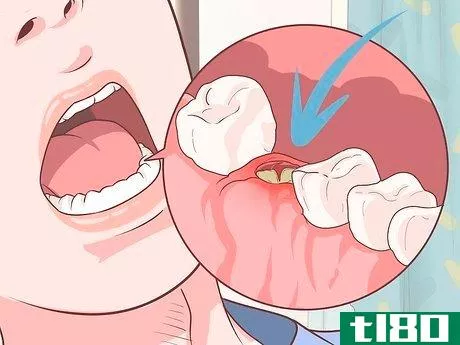 Image titled Prepare for Tooth Extraction Step 13