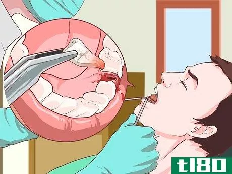 Image titled Prepare for Tooth Extraction Step 10