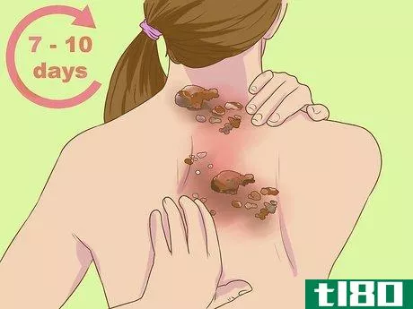 Image titled Recognize Shingles Symptoms (Herpes Zoster Symptoms) Step 6