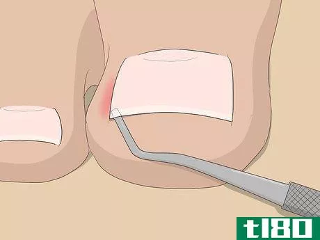Image titled Relieve Ingrown Toe Nail Pain Step 15