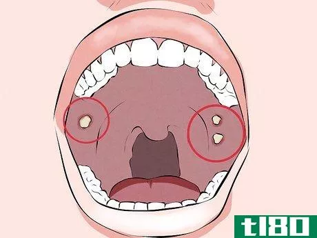 Image titled Recognize Signs of Oral Cancer Step 2