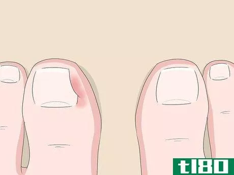 Image titled Relieve Ingrown Toe Nail Pain Step 1