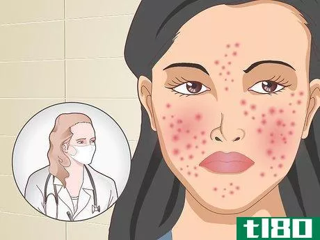 Image titled Prevent Acne Naturally Step 18