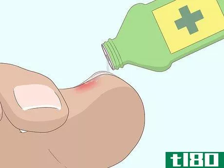 Image titled Relieve Ingrown Toe Nail Pain Step 16