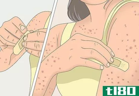 Image titled Prevent Chicken Pox Scars Step 10