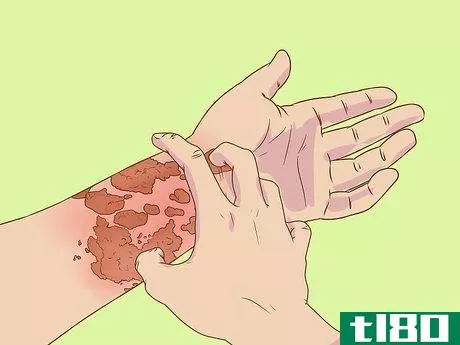 Image titled Recognize Shingles Symptoms (Herpes Zoster Symptoms) Step 4