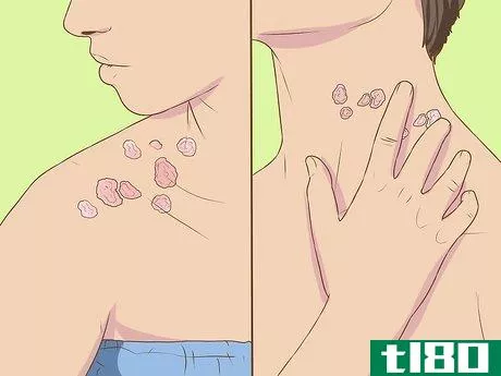 Image titled Recognize Shingles Symptoms (Herpes Zoster Symptoms) Step 2