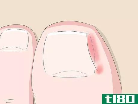 Image titled Relieve Ingrown Toe Nail Pain Step 3