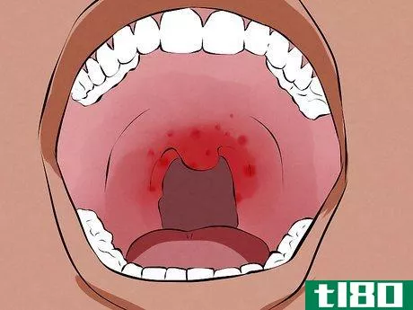 Image titled Recognize Signs of Oral Cancer Step 3