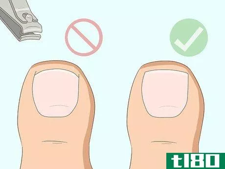 Image titled Relieve Ingrown Toe Nail Pain Step 27