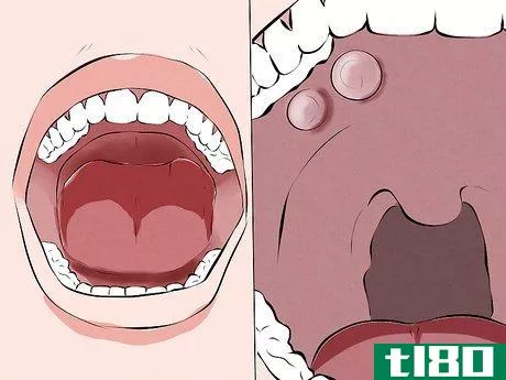 Image titled Recognize Signs of Oral Cancer Step 4