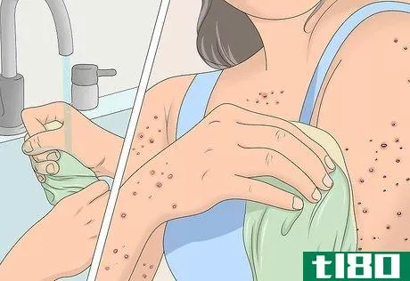 Image titled Prevent Chicken Pox Scars Step 4