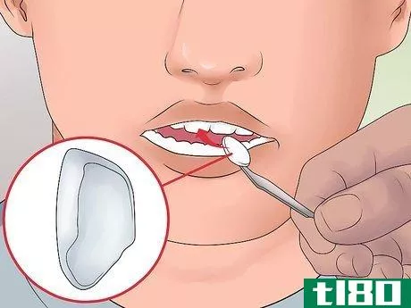 Image titled Avoid Getting Braces Step 6