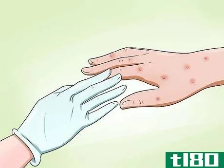 Image titled Avoid Getting Chicken Pox While Helping an Infected Person Step 5