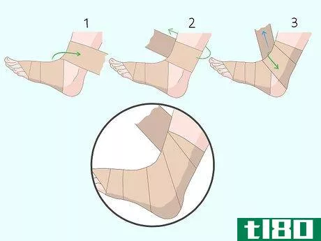 Image titled Wrap an Ankle with an ACE Bandage Step 5