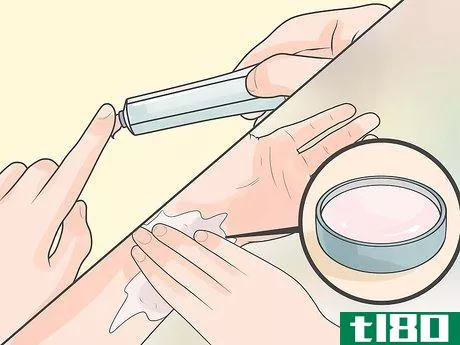 Image titled Remove an Ingrown Hair Under the Skin Step 11