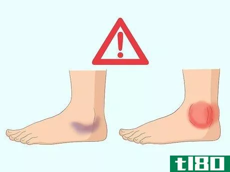 Image titled Wrap an Ankle with an ACE Bandage Step 17