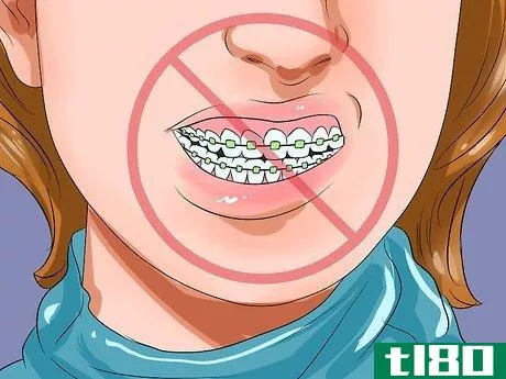 Image titled Clean Teeth With Braces Step 11