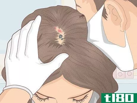 Image titled Bumps on Scalp Step 18