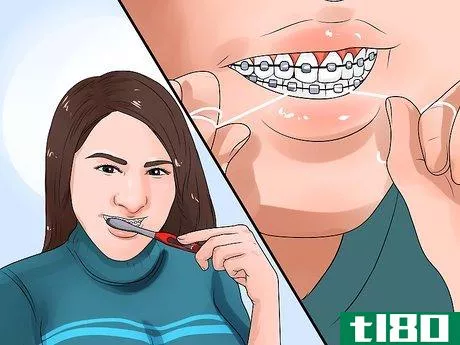 Image titled Clean Teeth With Braces Step 8