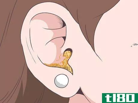 Image titled Tell if You Have an Ear Infection Step 2