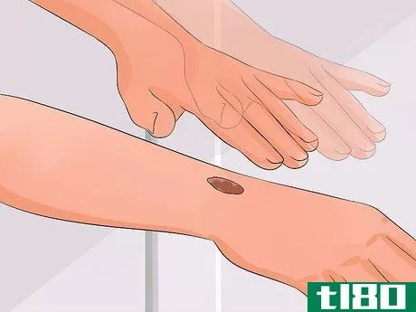 Image titled Stop Picking Your Scabs Step 10