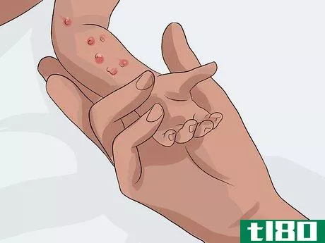 Image titled Spot Meningitis in Babies Step 6