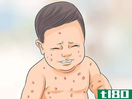 Image titled Spot Meningitis in Babies Step 11