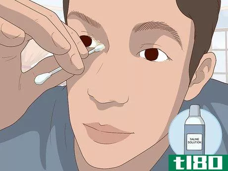 Image titled Clean a Prosthetic Eye Step 4.jpeg